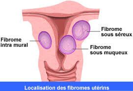 Fibrome - Les traitements médicamenteux du fibrome utérin - Doctissimo