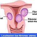 Comment traiter efficacement le fibrome sans la chirurgie 
