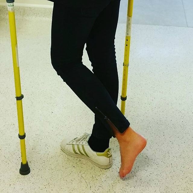  Sprained ankle, crutches and footbare