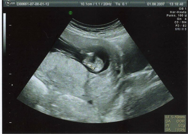 1 L Echo Des 12 Sa Album Photos En Attendant Bebe